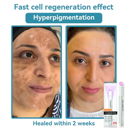 ✨ Lummvra™ All-in-One CO₂ Laser Eraser Pen | Removes Moles, Warts, Skin Flaws & Pigmentation