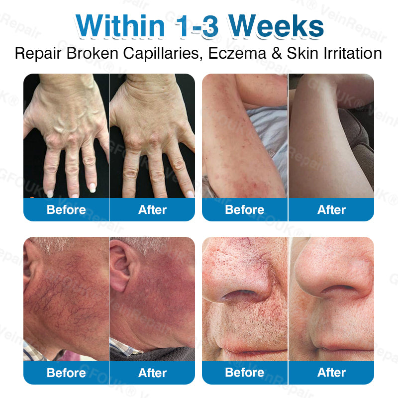 🏙️NATRAVOR® VeinRepair Microneedle Patch Roll⚡Instant Relief, Long-Term Results