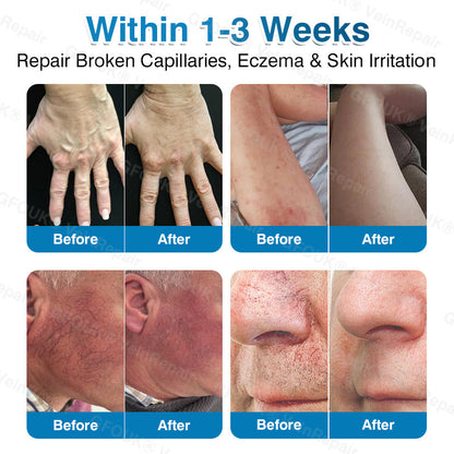 🏙️NATRAVOR® VeinRepair Microneedle Patch Roll⚡Instant Relief, Long-Term Results
