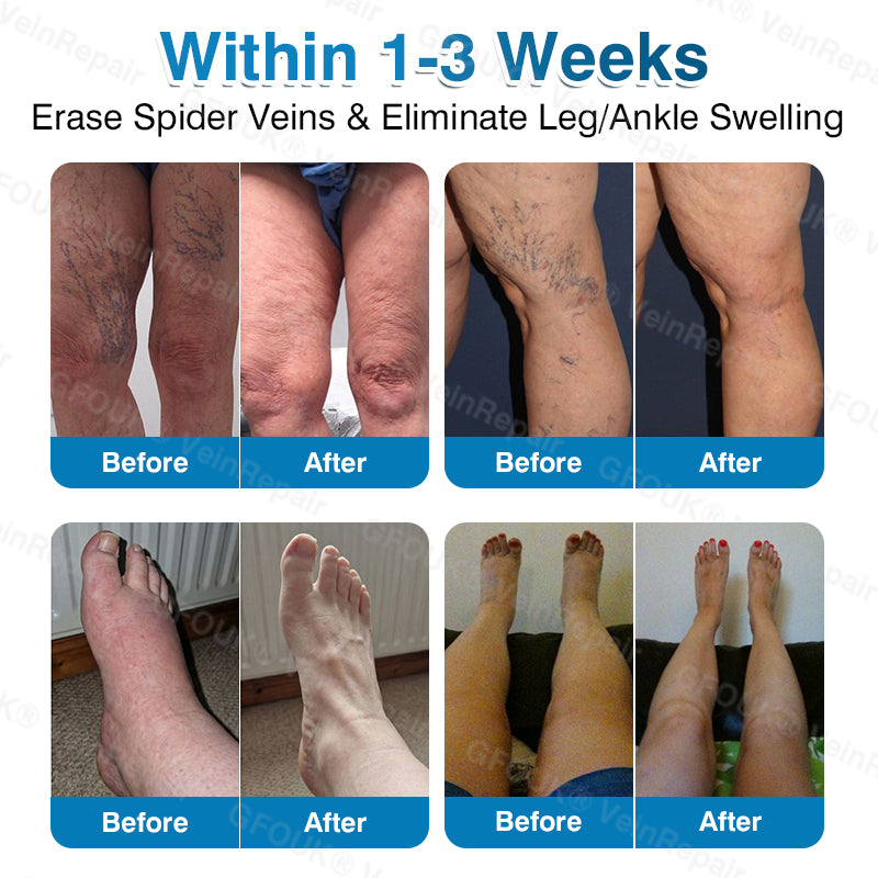 🏙️NATRAVOR® VeinRepair Microneedle Patch Roll⚡Instant Relief, Long-Term Results