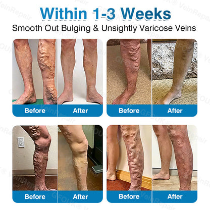 🏙️NATRAVOR® VeinRepair Microneedle Patch Roll⚡Instant Relief, Long-Term Results