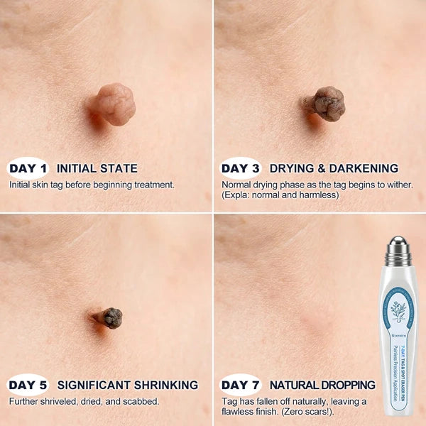 𝐎𝐟𝐟𝐢𝐜𝐢𝐚𝐥 𝐁𝐫𝐚𝐧𝐝 𝐒𝐭𝐨𝐫𝐞 |🖊️Nonviro® 7-𝐷𝑎𝑦 𝗧𝐚𝐠 & 𝗦𝗽𝐨𝐭 𝐄𝐫𝒂𝒔𝒆𝒓(Zero Pain, Zero 𝐒𝐜𝐚𝒓𝒔 Rollerball)🖊️✨