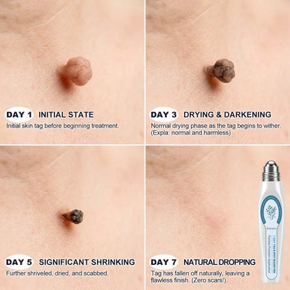 𝐎𝐟𝐟𝐢𝐜𝐢𝐚𝐥 𝐁𝐫𝐚𝐧𝐝 𝐒𝐭𝐨𝐫𝐞 |🖊️Nonviro® 7-𝐷𝑎𝑦 𝗧𝐚𝐠 & 𝗦𝗽𝐨𝐭 𝐄𝐫𝒂𝒔𝒆𝒓(Zero Pain, Zero 𝐒𝐜𝐚𝒓𝒔 Rollerball)🖊️✨