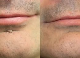 ✨NATRAVOR®2-in-1 Microneedle & Hydrocolloid Patch🍀| Removes Raised Moles, Acne, Flat Warts & Skin Tags | Helps Improve Wrinkles, Scars & Blemishes | Invisible Patches for Face & Body