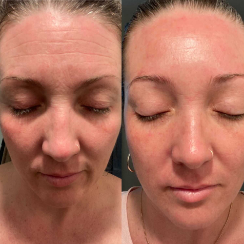 Lummvra® 10-in-1 Advanced Nano Microneedle Patches